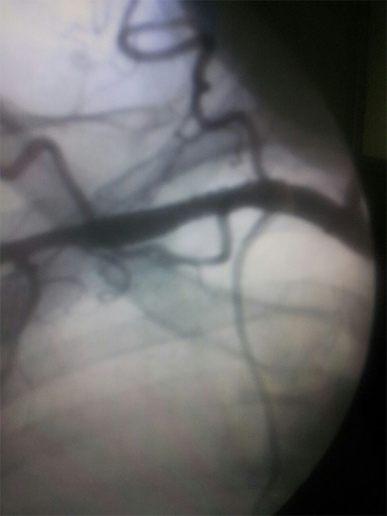 Subclavian Stenting Post